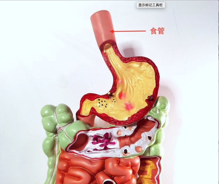 生存率以及提高生存质量的关键在于"三早",即"早发现,早诊断和早治疗"