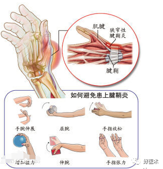 wt-1 腕关节活动度练习 轻柔的向前弯曲腕关节(屈曲),在最屈曲的位置