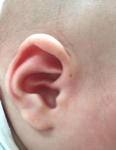 老一辈说小孩耳朵有小洞是有福气的一种象征但事实却并非如此