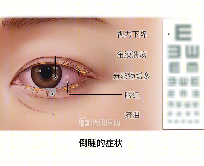 注意!这是眼部疾病,出现4种