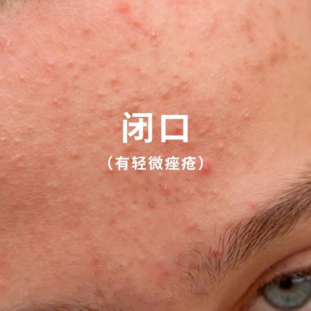 "脂肪粒"抠不出脂肪,闭口和黑头其实是一家人