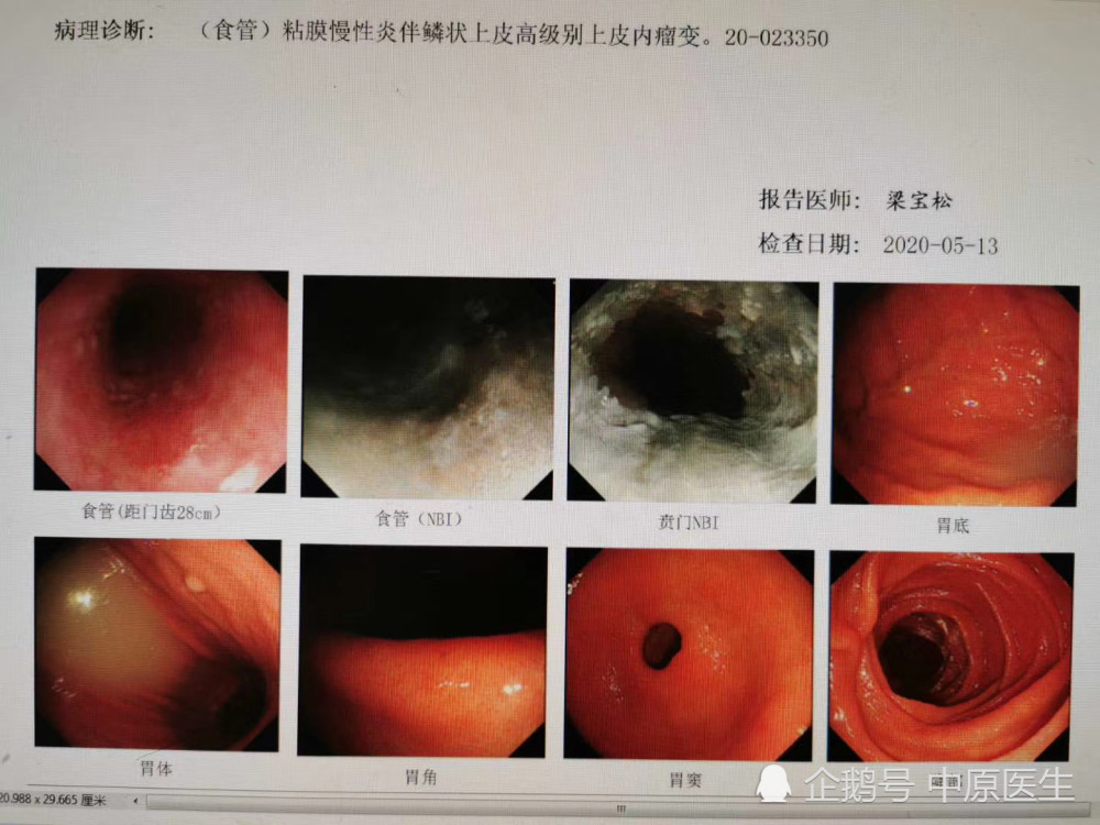 专家重新给患者做内镜,查出早期食管癌