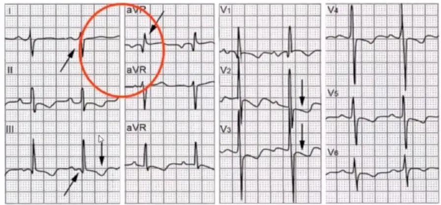 急性肺栓塞心电图改变多达30几种你一定数不全