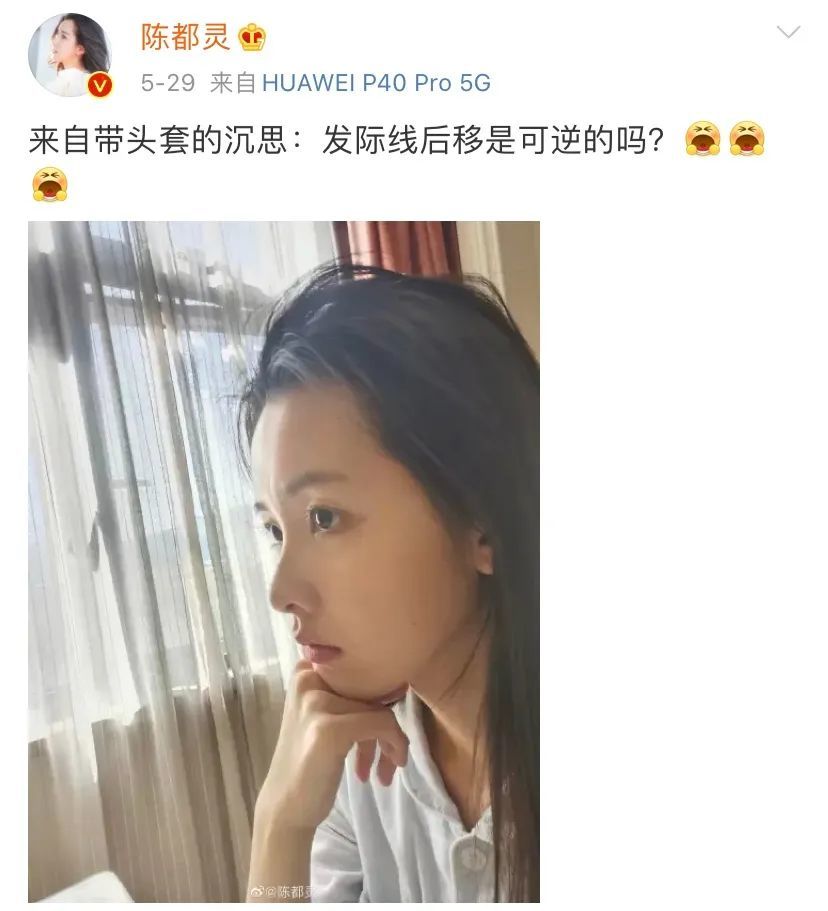 陈都灵在线发问：发际线后移是可逆的吗？