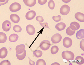 外周血细胞形态学室间质评合辑——红细胞
