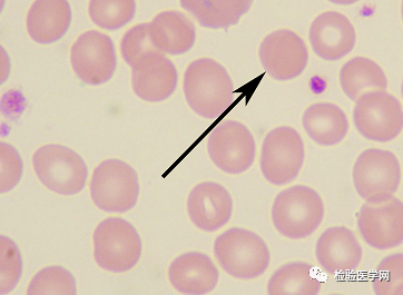 外周血细胞形态学室间质评合辑—红细胞