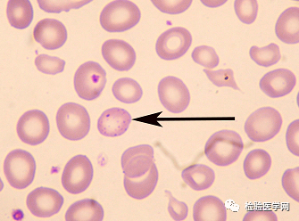 外周血细胞形态学室间质评合辑——红细胞
