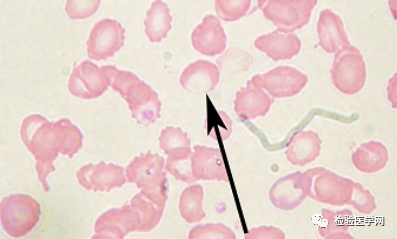 外周血细胞形态学室间质评合辑—红细胞