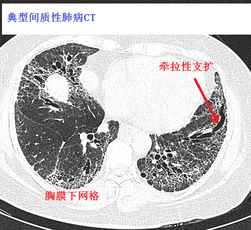 结缔组织病继发间质性肺炎的影像学特点 不同的结缔组织病,继发的间