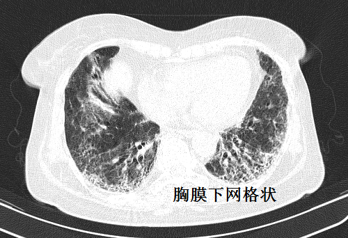 极易漏诊的间质性肺炎,从ct上怎么看?