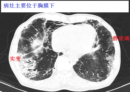 这个患者胸部ct提示间质性肺炎,且胸膜下有实变,需要警惕皮肌炎