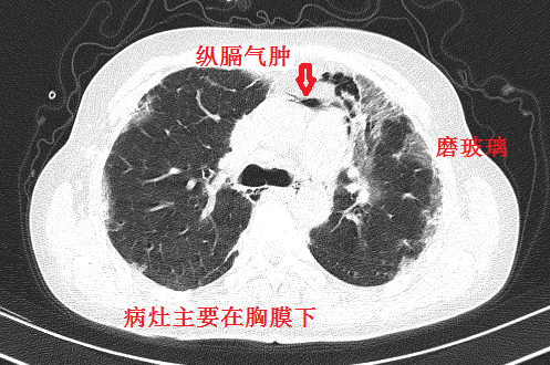 ▎相对典型的ct 纵隔气肿是皮肌炎相关间质性肺病的特色,其