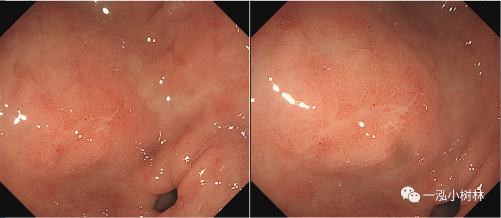 例 65岁男性患者,胃窦前壁iic早期胃癌.