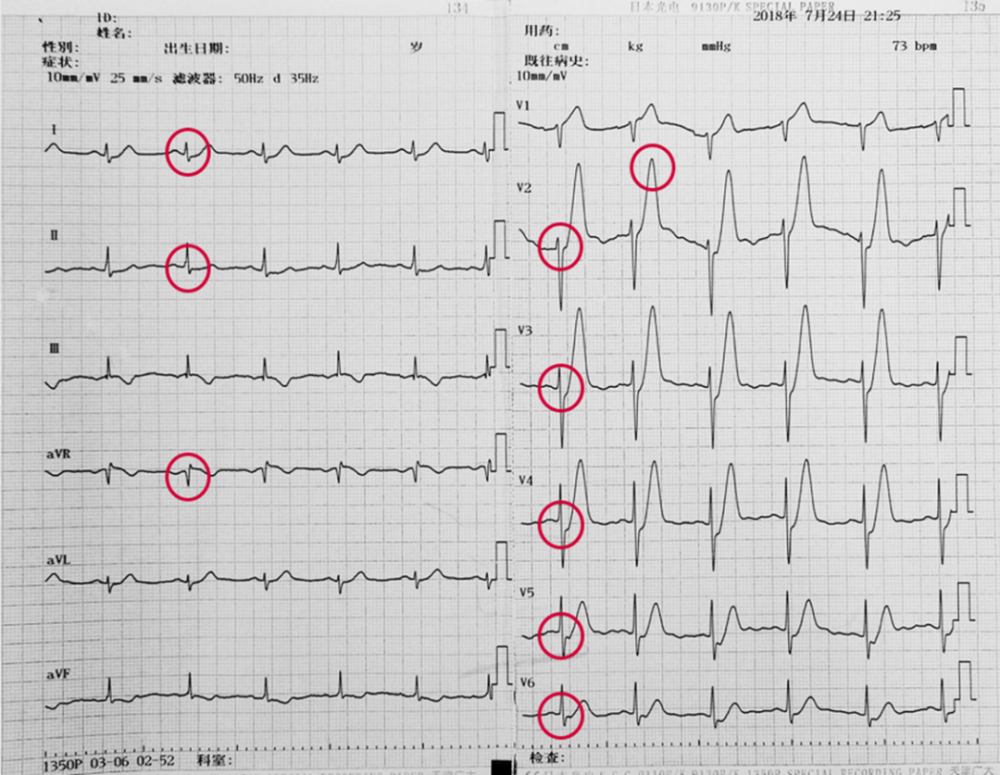 winter综合征:avr导联st段抬高,其余导联st段上斜形压低,伴有t波高尖