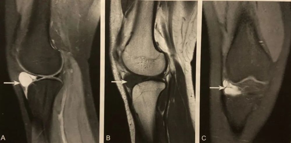 【骨科小技巧】半月板囊肿影像的阅片要点!