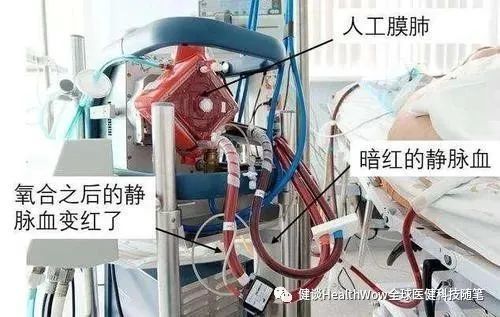 ecmo(叶克膜)机