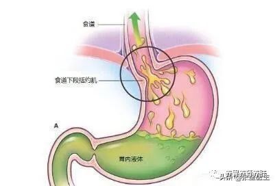 总是反酸,烧心?医生懂你的困扰,深度解读:护胃从此刻开始