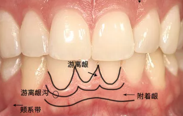 牙龈萎缩还有救