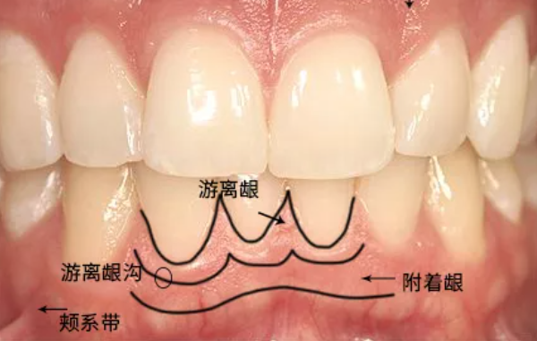 先来认认这些牙龈组织,牙龈组织包含游离龈,附着龈和龈乳头三部分有