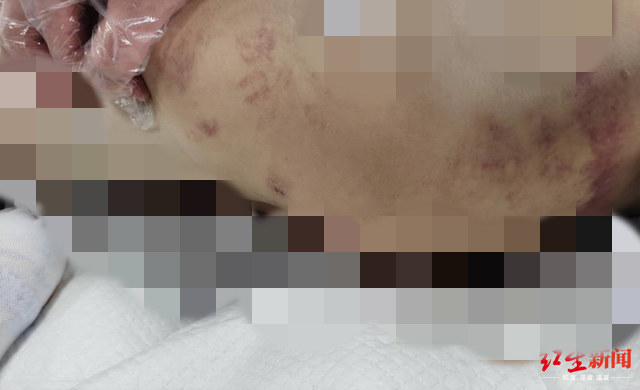 残忍！12岁女儿遭继母虐打，脑梗死住进ICU，生父差点晕倒