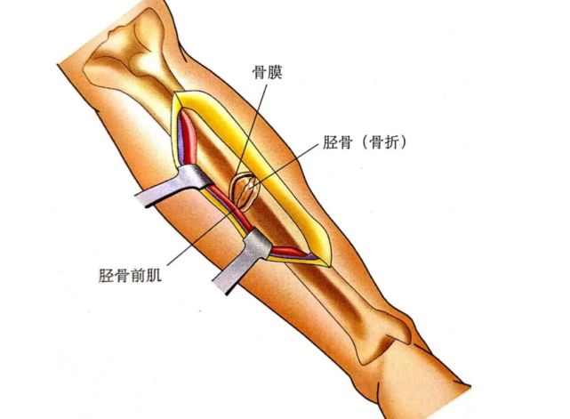 胫骨干骨折:钢板螺钉内固定术