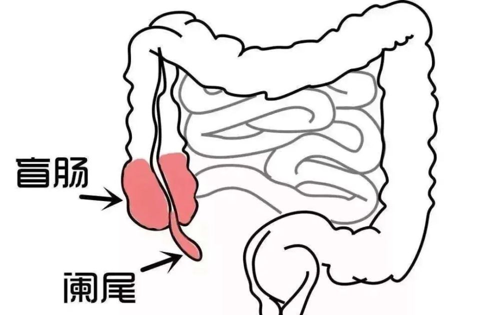 阑尾位于回肠与盲肠交界处,开关如同一条蚯蚓,与成年人的小手指差不多