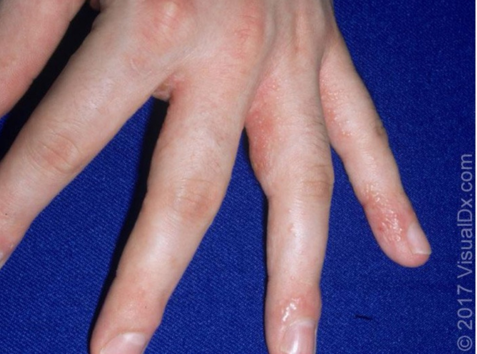 轻度汗疱疹只在手指侧面出现水泡.