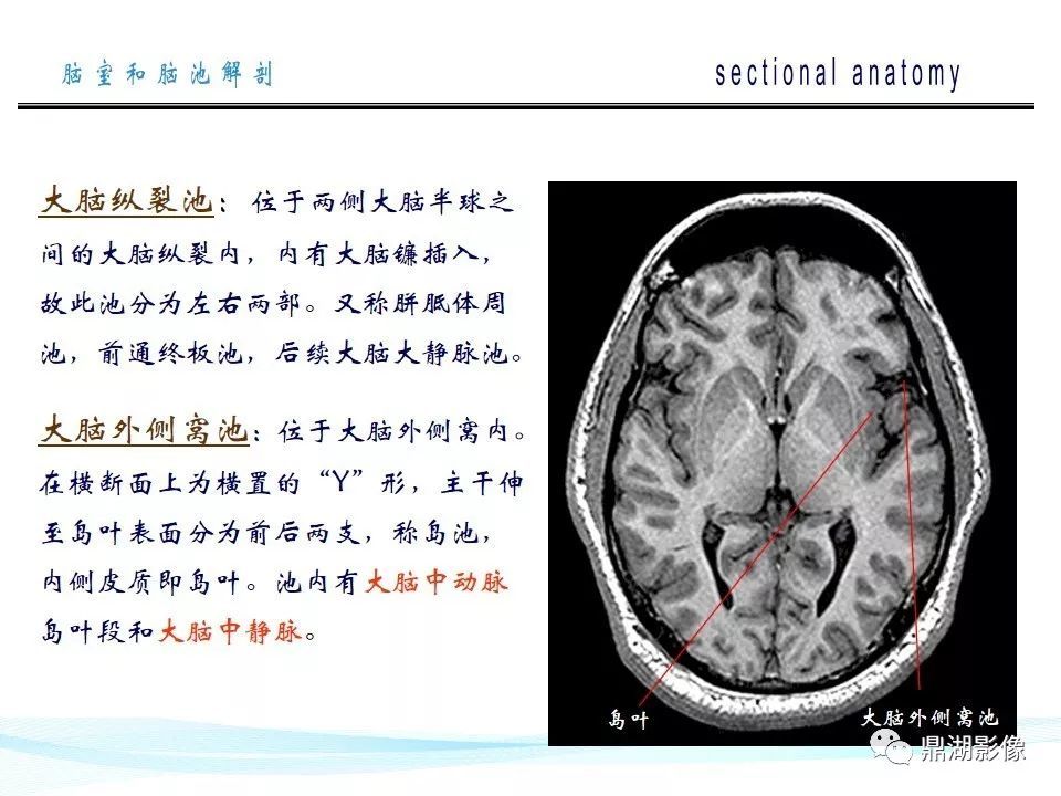 超全详解:脑池和脑室断层解剖