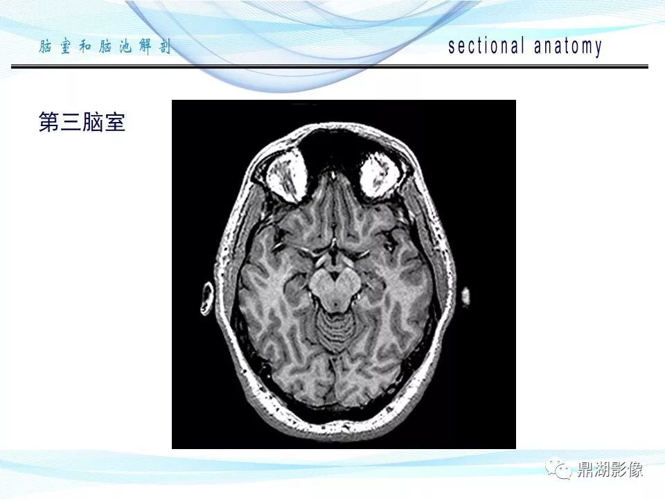 超全详解:脑池和脑室断层解剖