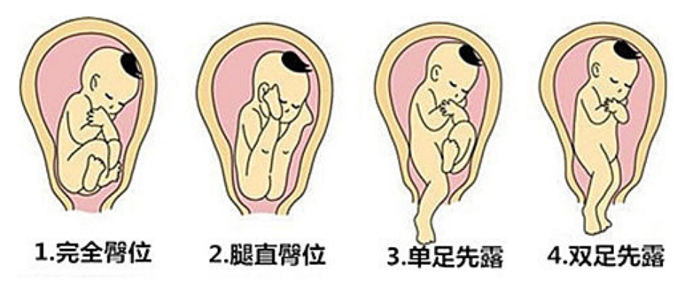 16分钟顺产下8斤重"臀位宝宝?这…太难了吧?