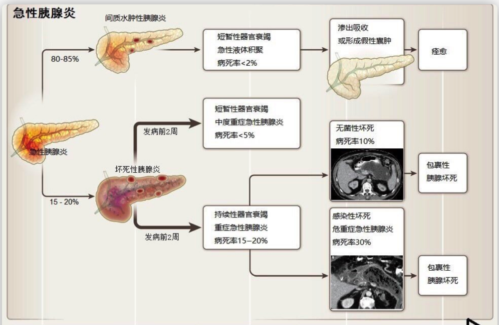 身为炎症却致命,别小看急性胰腺炎,5大病因4个预防措施在这里