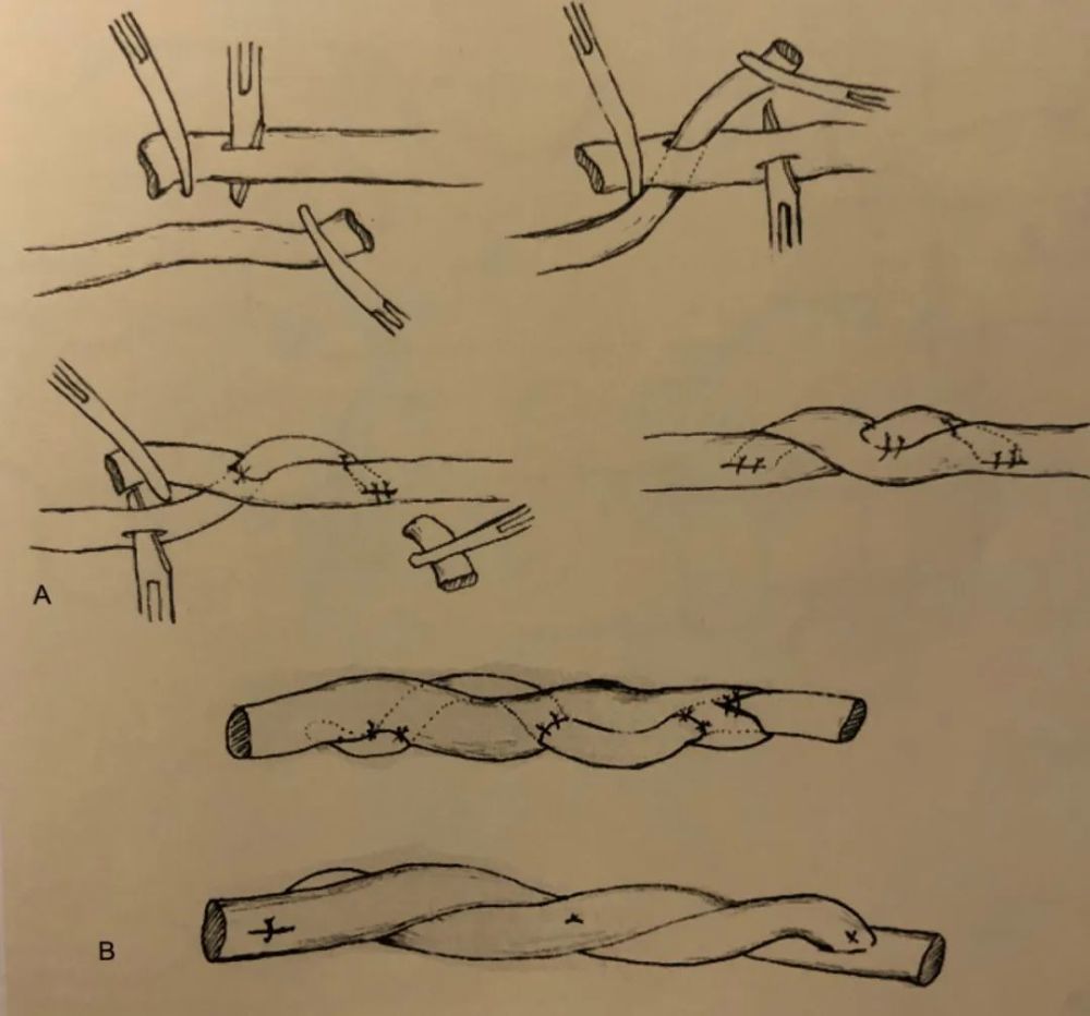 与其类似的有"8"字缝合法.
