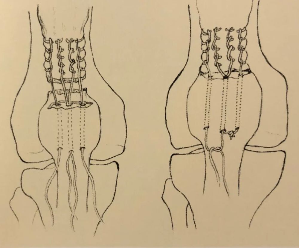 骨科医生基本功,常见缝合技术详解