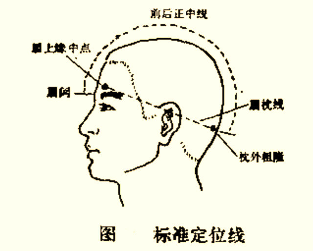 针灸:头针疗法具体运用方法