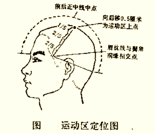 针灸头针疗法具体运用方法