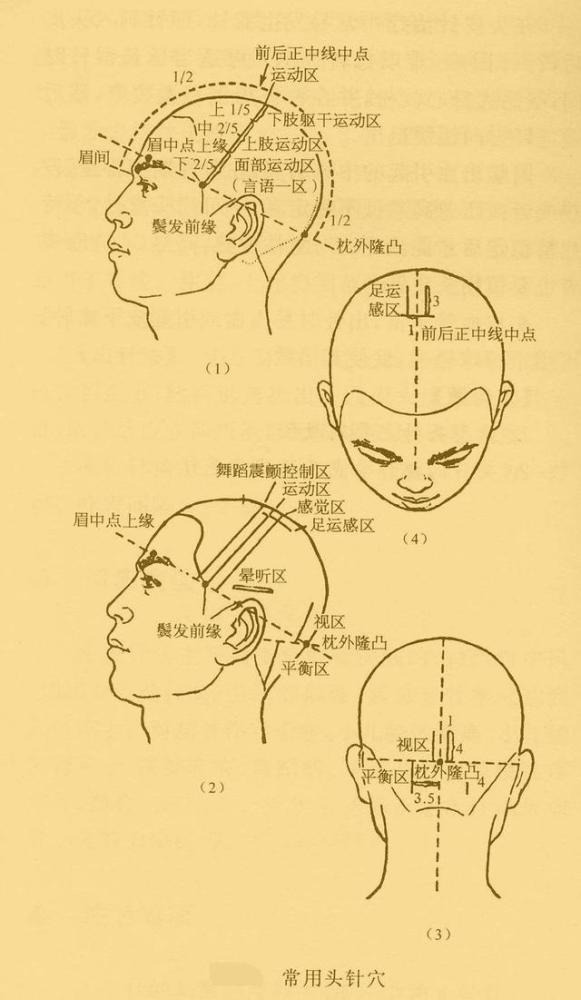 针灸:头针疗法具体运用方法