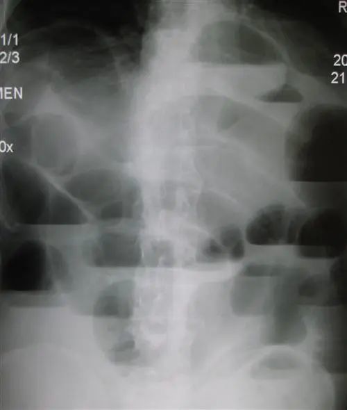 在临床上,我从来不给患者开腹部立位片检查,考虑肠梗阻,一定要做一个