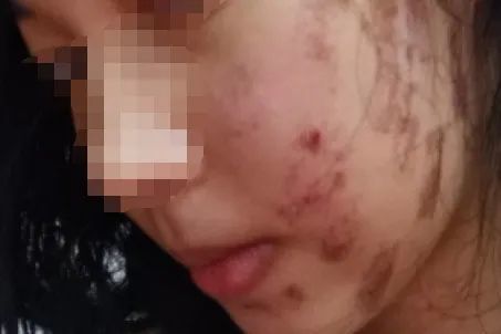 小姐姐在美容店做了"光子嫩肤",竟被烧伤"毁容"!