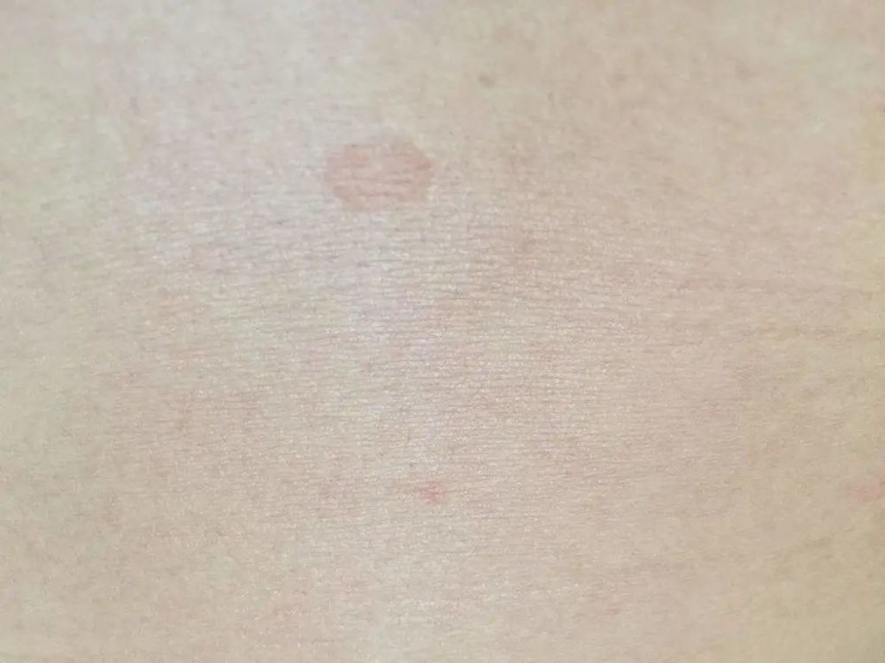 一到夏天前胸后背腋窝出现褐色圆形斑是啥会不会传染
