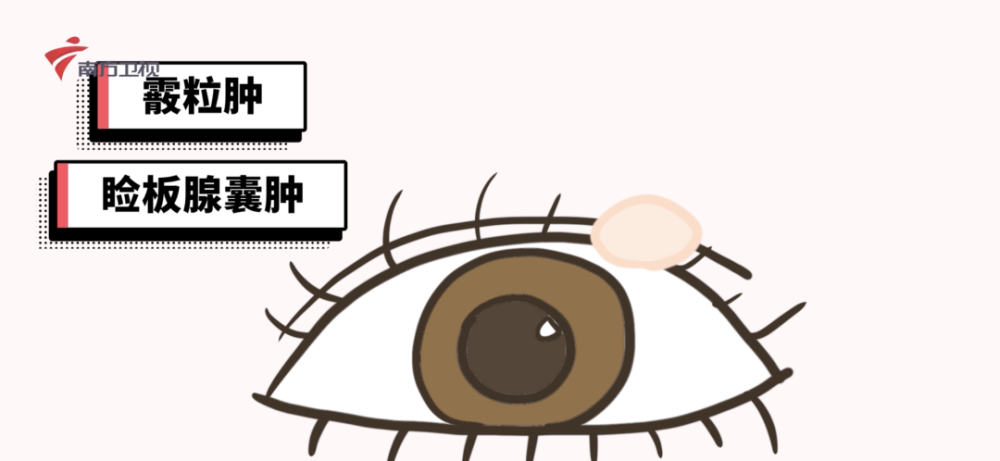 堵塞住了睑板腺导致的 它的症状是眼睑内外长出圆圆的白色颗粒 不痛