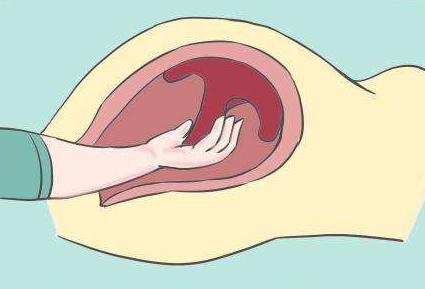 手剥胎盘是用手进去撕吗?哪些孕妇容易遭遇手剥胎盘?