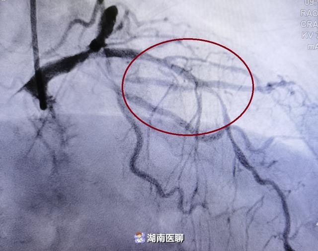 在跳动的心脏上进行左乳内动脉—前降支搭桥术