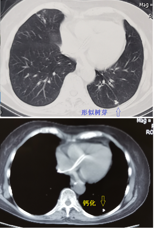 肺部ct基础读片认识树芽征