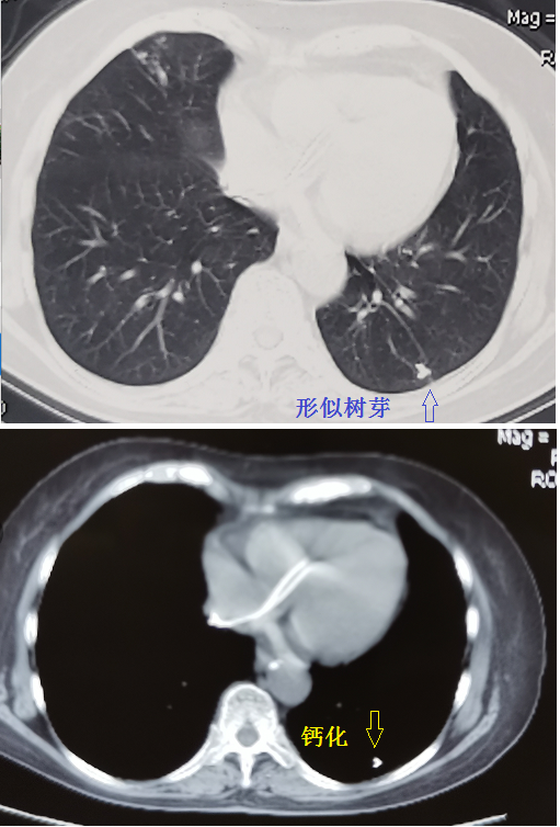 从肺窗看到树芽征,要看纵隔窗,有时候是无意义的钙化,见图2.