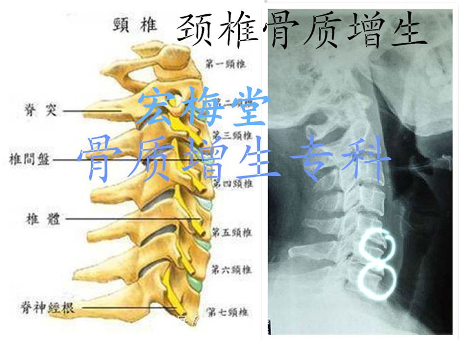 颈椎骨质增生 颈椎骨关节炎 颈椎病 骨质增生专科有些医生,只从症状