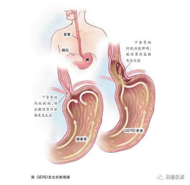 "慢性咳嗽"久治不愈!原来是胃食管反流病惹的祸