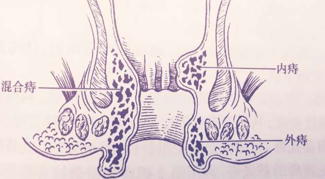 肛门疼痛是另一种较为常见的外痔症状,像血栓性外痔和炎性外痔都会使