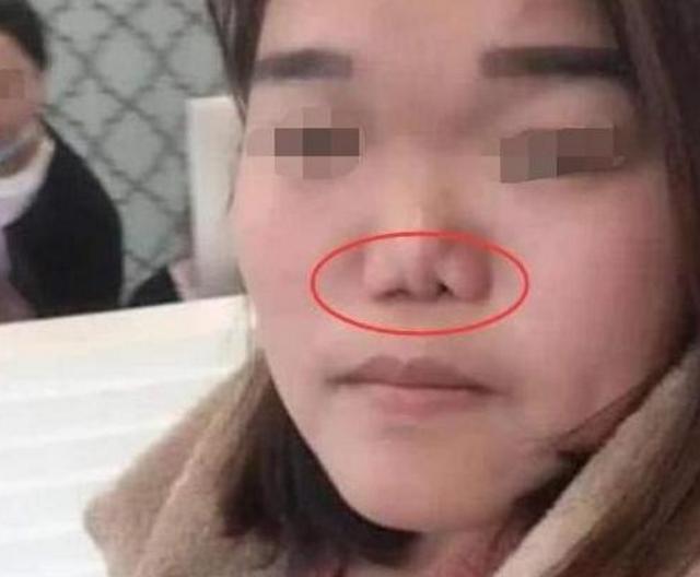一:鼻子变形,影响外貌
