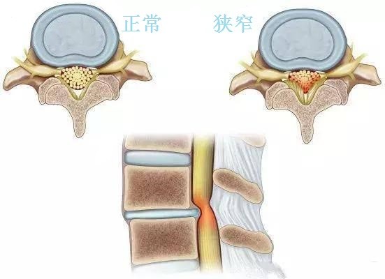 中老年人出现走走停停症状,需要注意腰椎管狭窄!