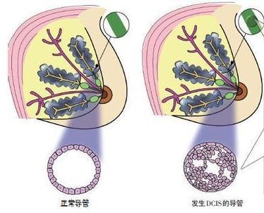 1级或高分化,3级或低分化乳腺癌代表什么?